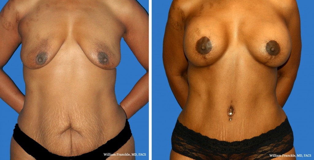 A before and after photo of a woman after her breasts were altered by Premier Plastic Surgery Arts in Sewell, NJ