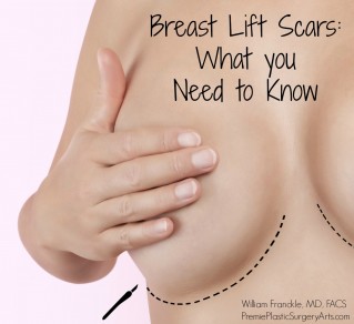 pinterest_breast-lift-scars
