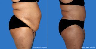 Tummy Tuck Side View Tummy Tuck Side View
