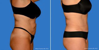Tummy Tuck Tummy Tuck