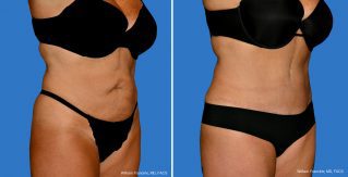 Tummy Tuck Front View Tummy Tuck Front View