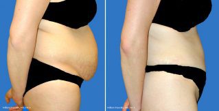 Tummy Tuck Side View Tummy Tuck Side View