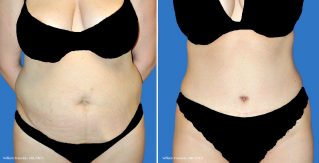 Tummy Tuck Front View Tummy Tuck Front View