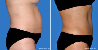 Tummy Tuck Side View