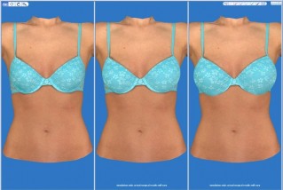 3D imaging prior to a breast surgery performed by William Franckle, MD, FACS in Voorhees, NJ