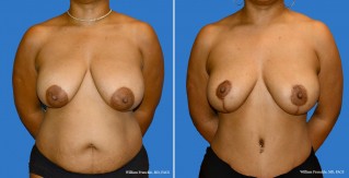 Breast Lift Front View