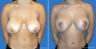 Breast Lift Front View