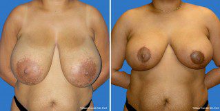 Breast Reduction Front View Breast Reduction Front View