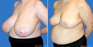 Breast Reduction Side View Breast Reduction Side View