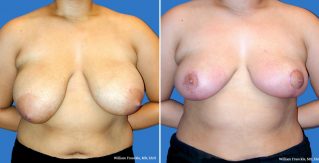 Breast Reduction Front View
