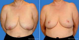 Breast Reduction Front View Breast Reduction Front View