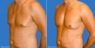 Male Breast Reduction Side View Male Breast Reduction Side View