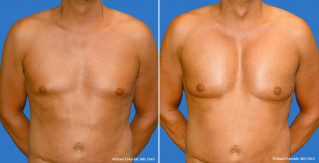 Male Breast Reduction Front View Male Breast Reduction Front View