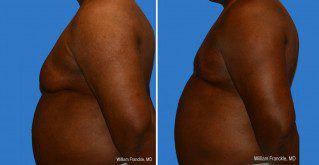 Male Breast Reduction Side View Male Breast Reduction Side View