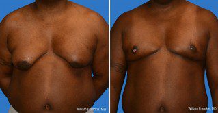 Male Breast Reduction Front View Male Breast Reduction Front View