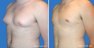Male Breast Reduction Side View Male Breast Reduction Side View