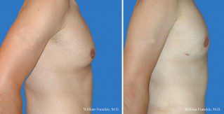 Male Breast Reduction Side View Male Breast Reduction Side View
