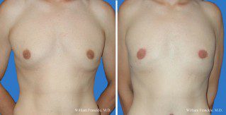 Male Breast Reduction Front view Male Breast Reduction Front View