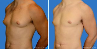 Male Breast Reduction Side View Male Breast Reduction Side View