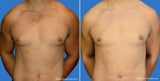 Male Breast Reduction Front View Male Breast Reduction Front View