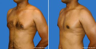 Male Breast Reduction Side View Male Breast Reduction Side View