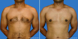 Male Breast Reduction Front View Male Breast Reduction Front View