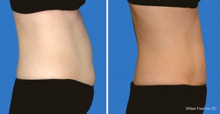 Liposuction Side View