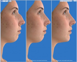 Side profile 3D imaging of a rhinoplasty patient prior to cosmetic surgery by William Franckle, MD, FACS in Voorhees, NJ