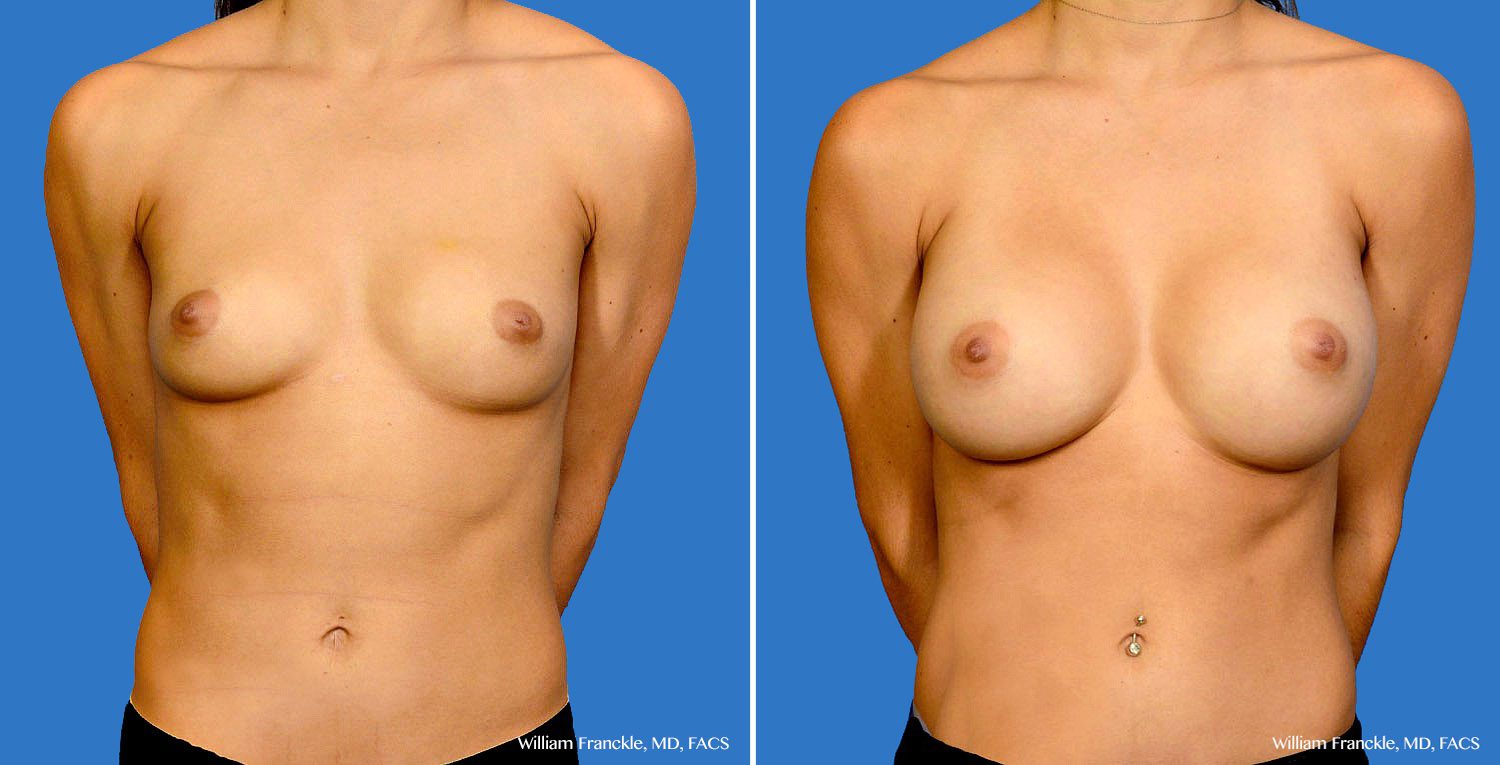 patient43_front