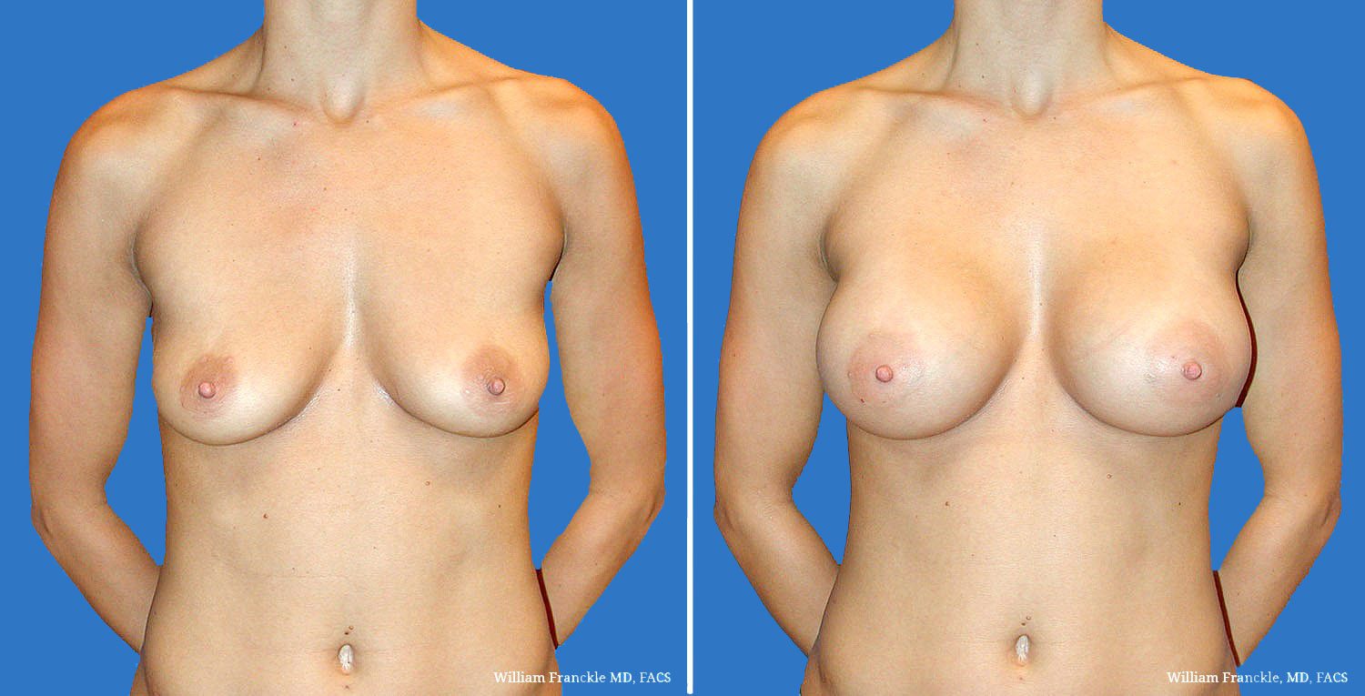 patient49_front