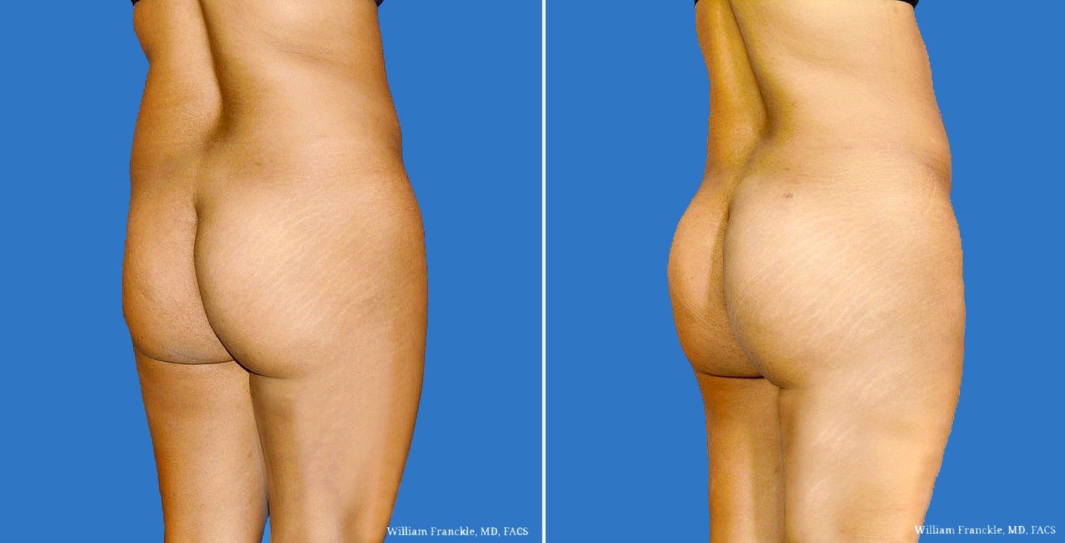 Butt-Augmentation-Patient1A