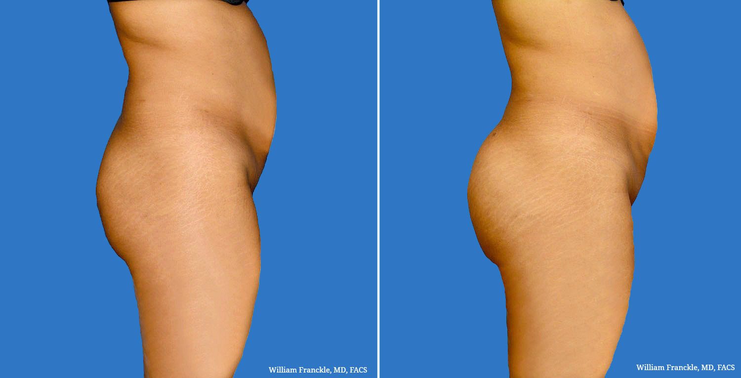 Butt-Augmentation-Patient1Bjpg