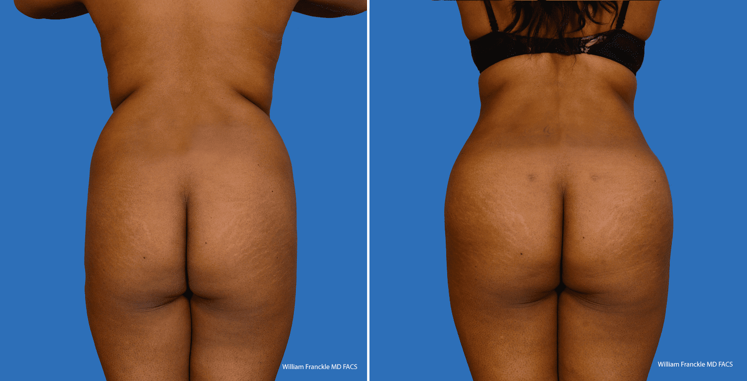 patient103_back